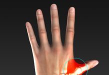 Rhizarthrose: Hilfe für “Leiden fleißiger Frauen” Rhizarthrose: Schmerzen